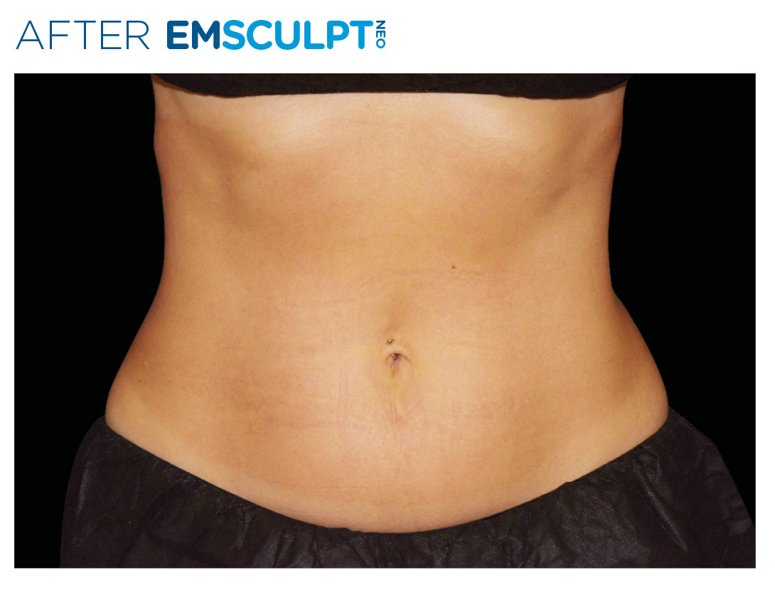 Abdomen after Emsculpt NEO treatment