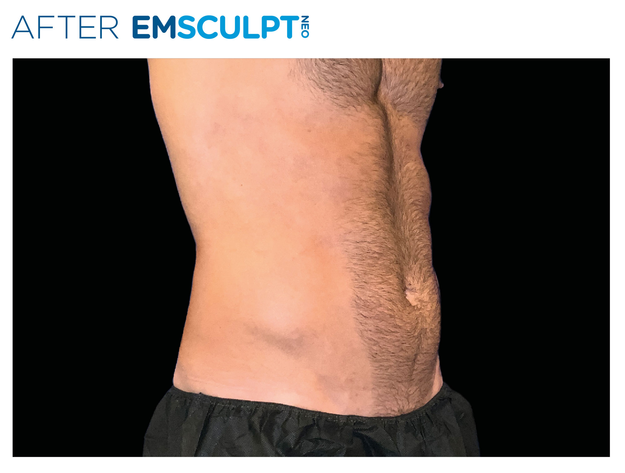 Abdomen after Emsculpt NEO treatment