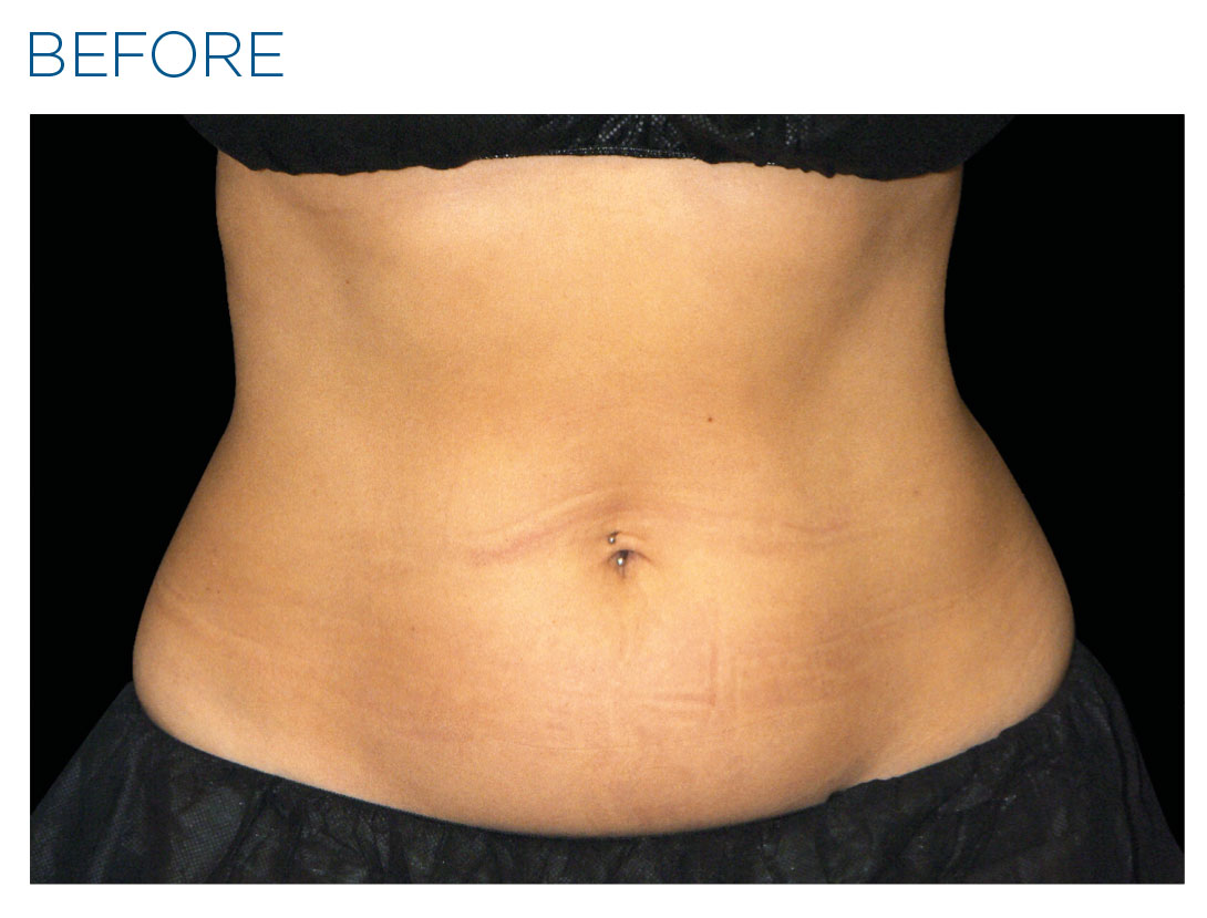 Abdomen before Emsculpt NEO treatment