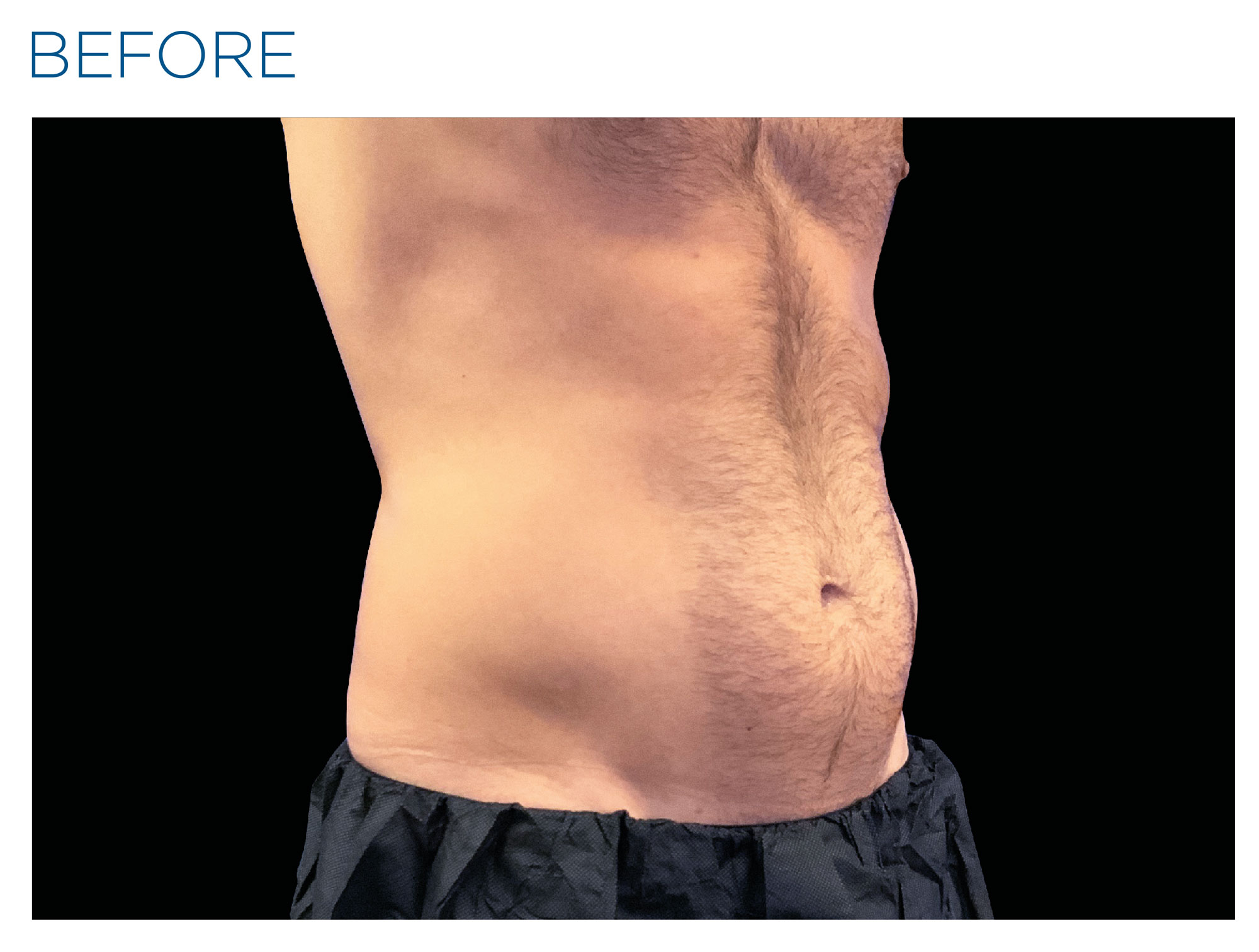 Abdomen before Emsculpt NEO treatment