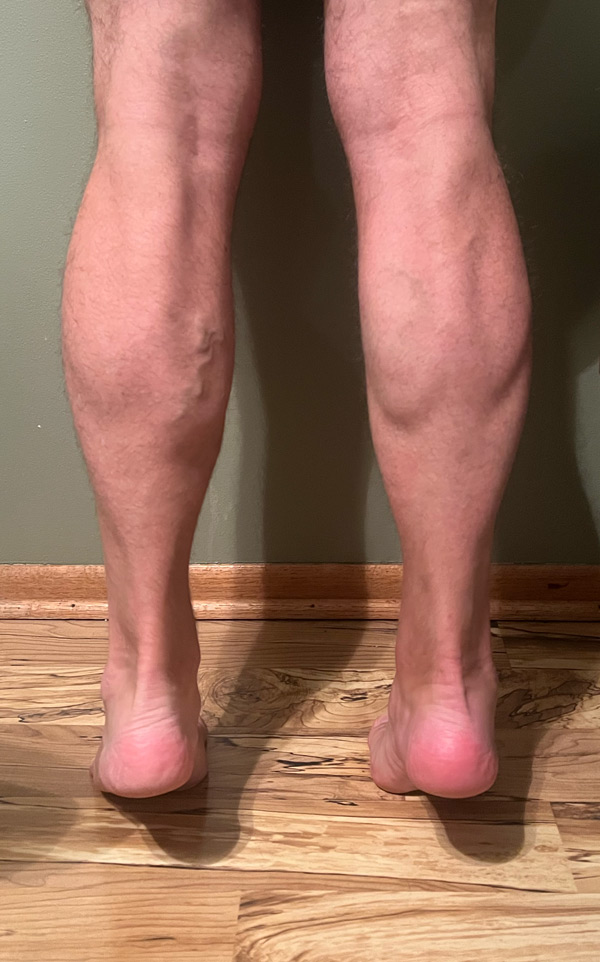 After Emsculpt treatment - right calf showing improved muscle definition