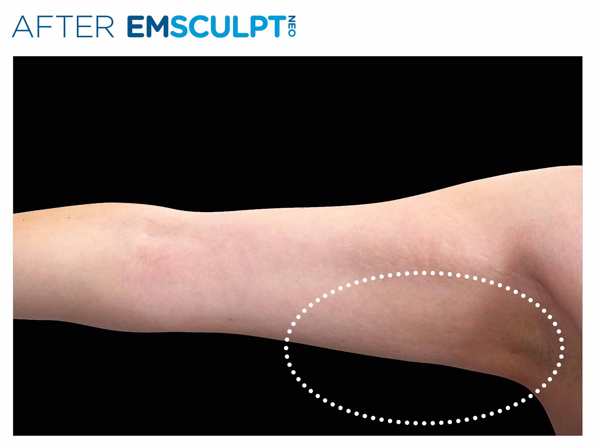Arms after Emsculpt NEO treatment