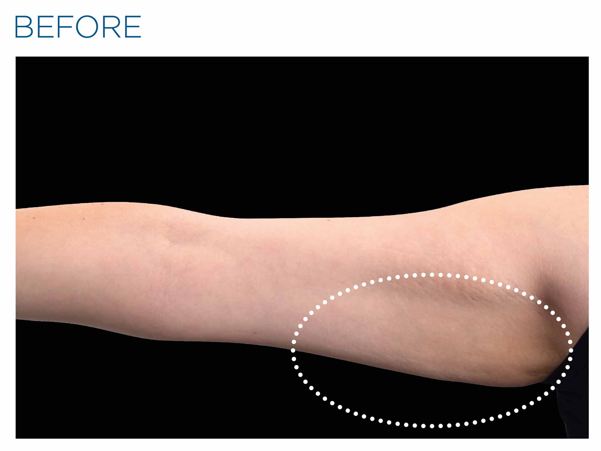 Arms before Emsculpt NEO treatment