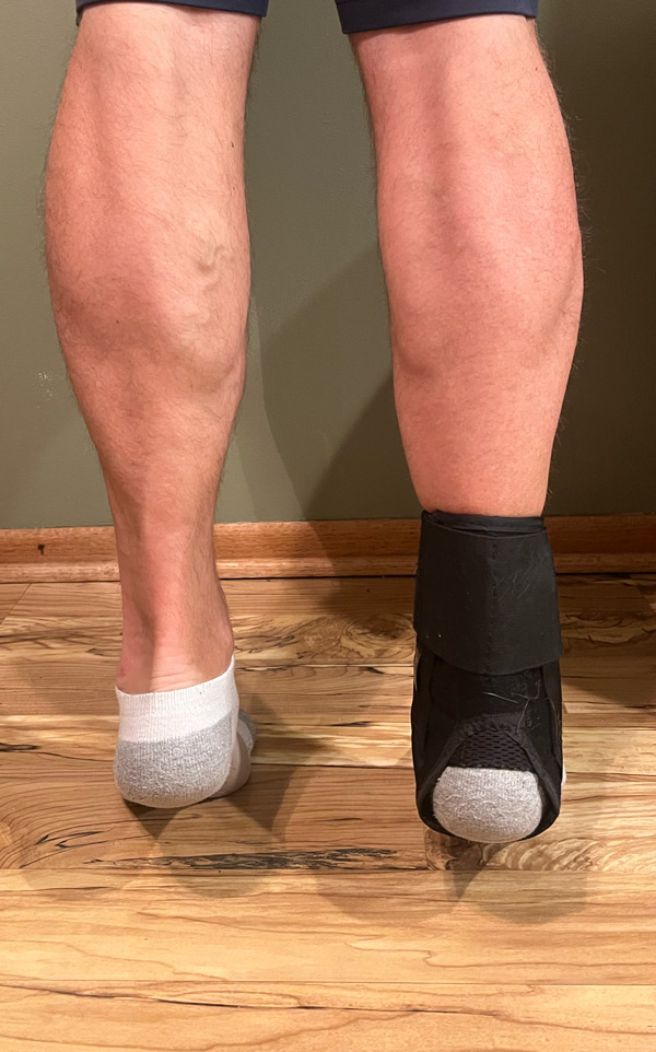 Before Emsculpt treatment - right calf showing muscle atrophy after surgery