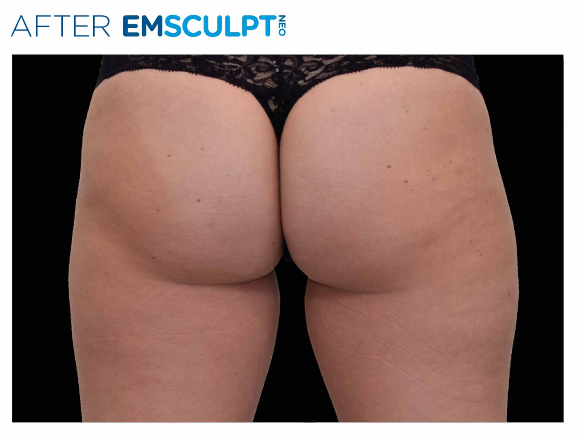 Buttocks after Emsculpt NEO treatment
