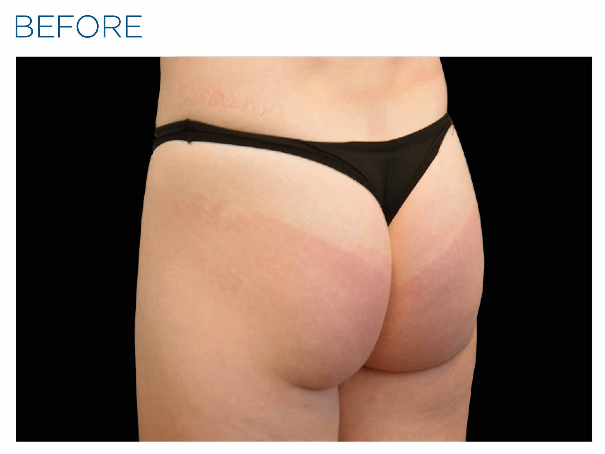 Buttocks before Emsculpt NEO treatment