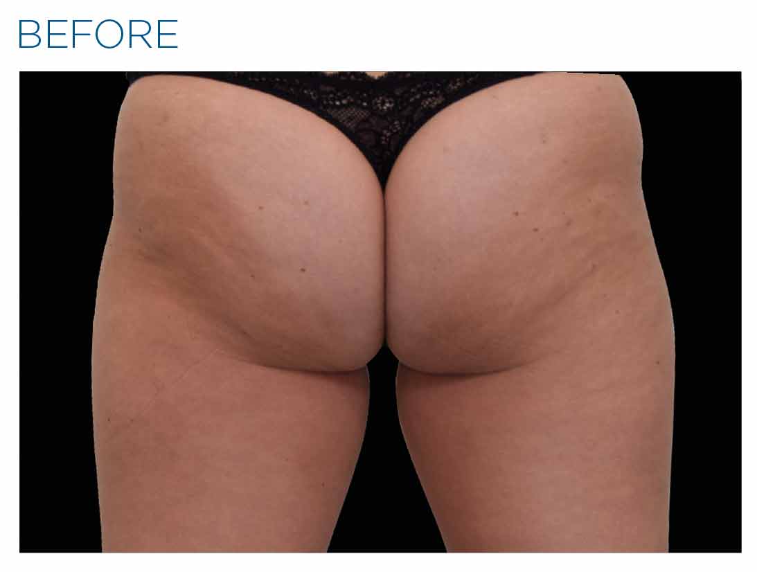 Buttocks before Emsculpt NEO treatment